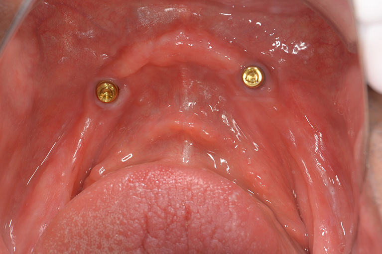 口腔内のインプラント